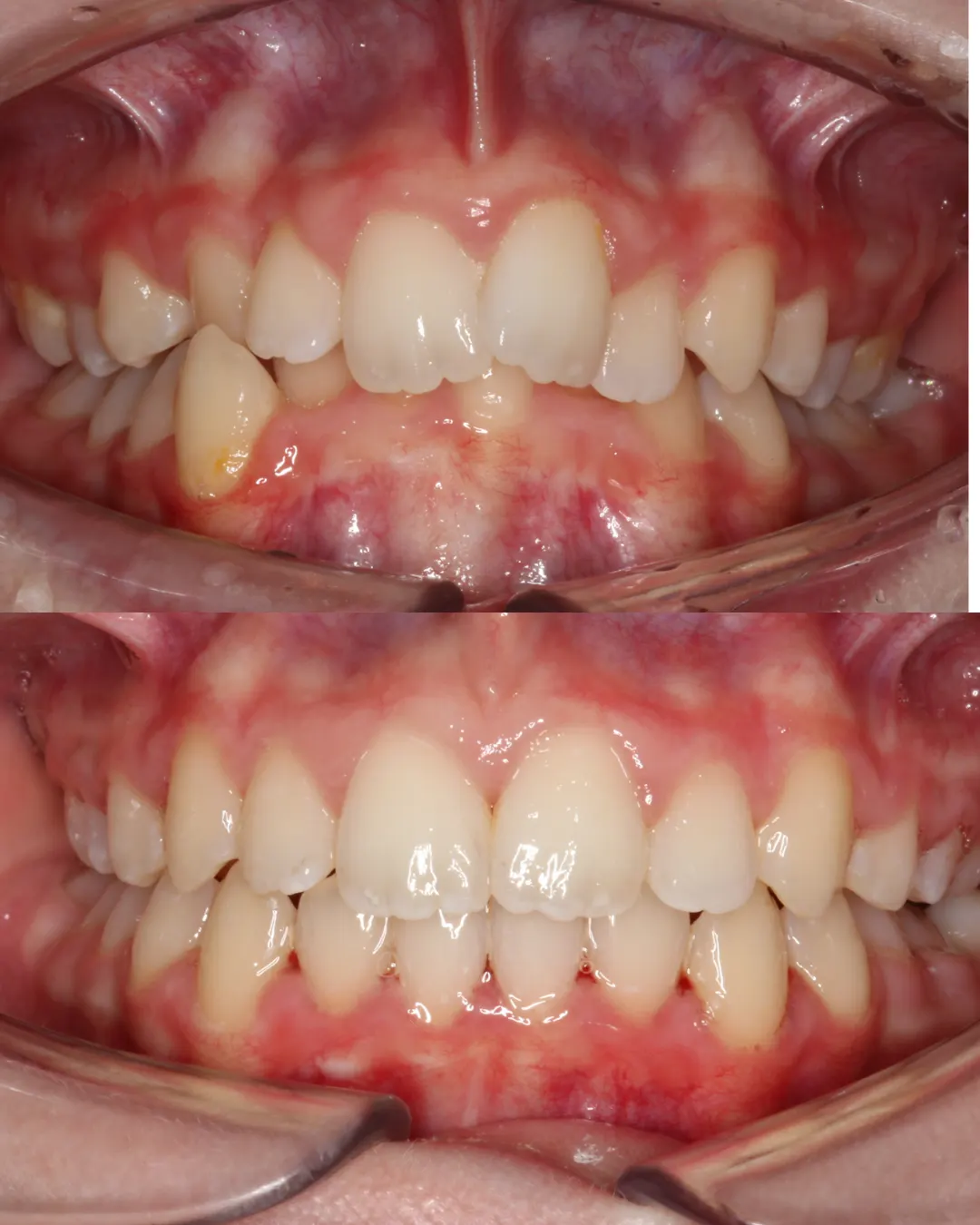 Before and after: upper and lower views of a patient's teeth treated with braces (case 7 of 7)