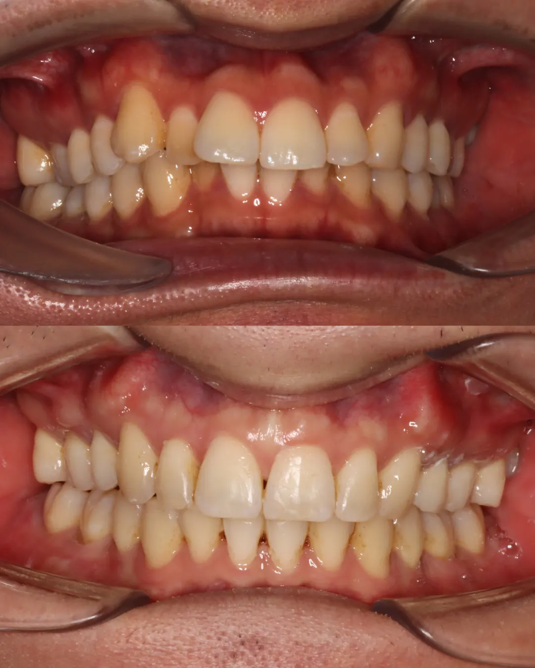 Before and after: upper and lower views of a patient's teeth treated with braces (case 6 of 7)