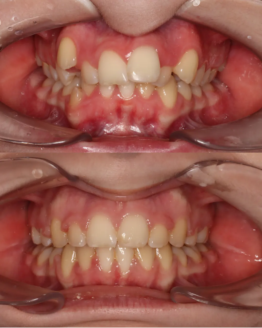 Before and after: upper and lower views of a patient's teeth treated with braces (case 4 of 7)