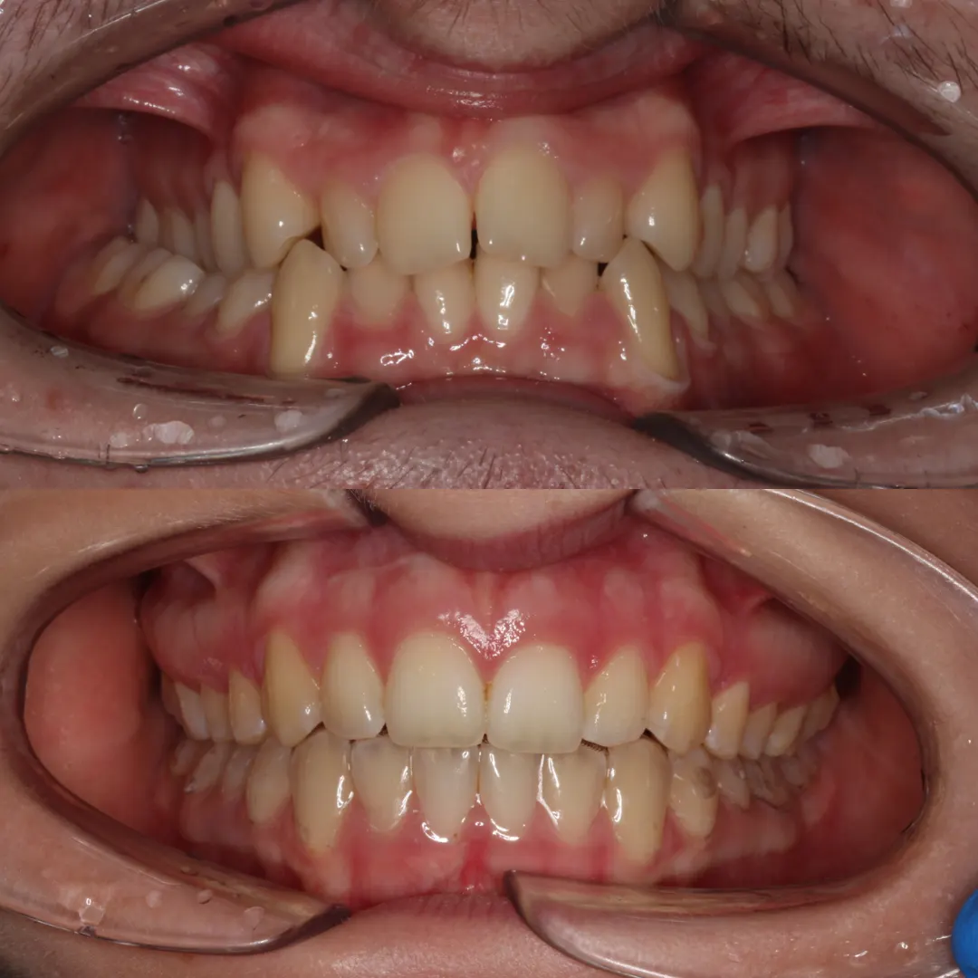 Before and after: upper and lower views of a patient's teeth treated with braces (case 3 of 7)