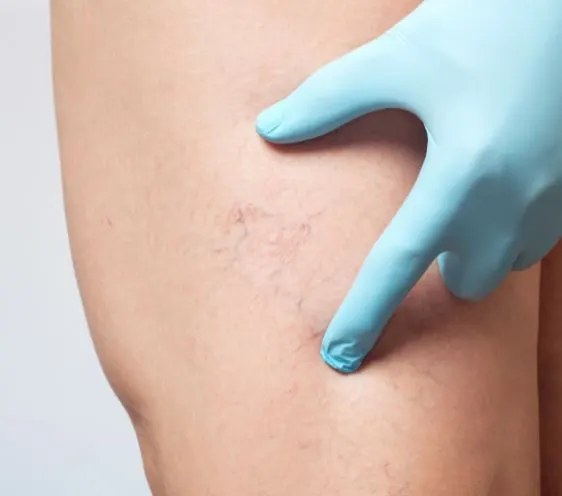 A gloved hand pointing to thread veins on a leg