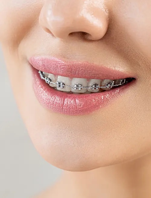 Traditional Fixed Braces