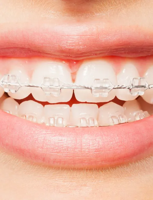 Clear Braces