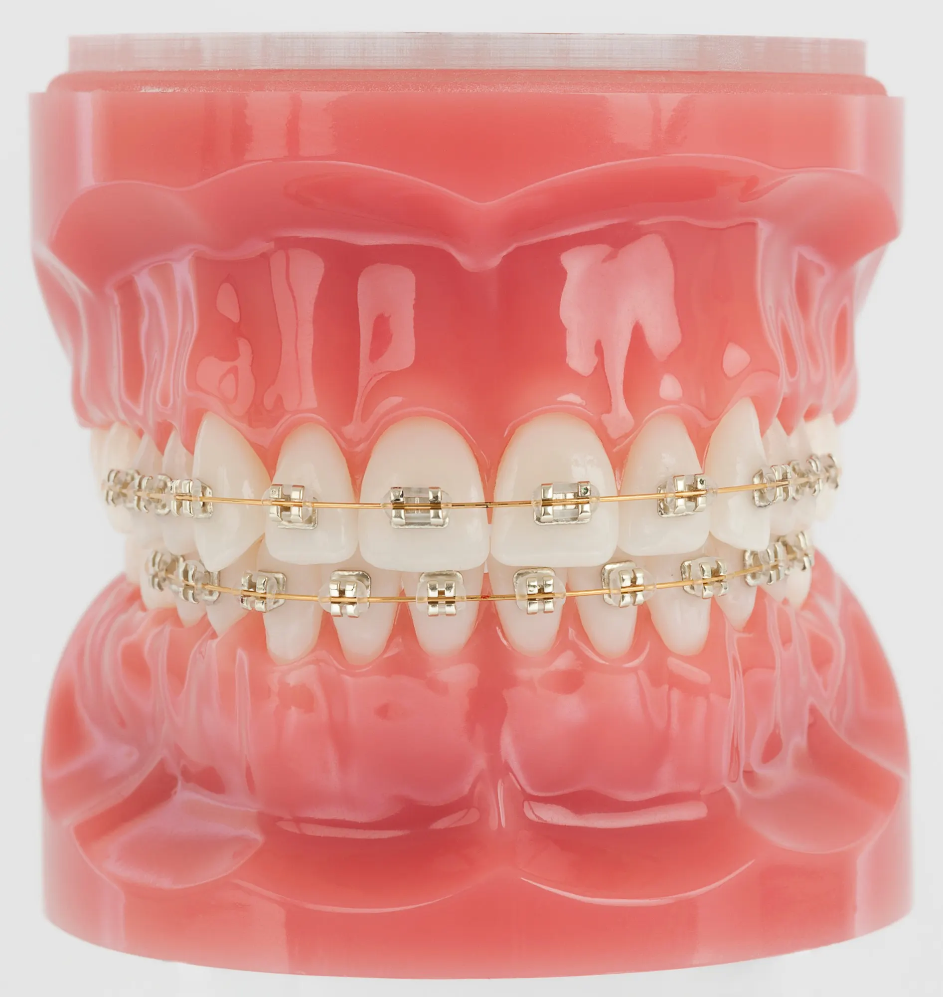 Iconix® aesthetic braces on a dental model