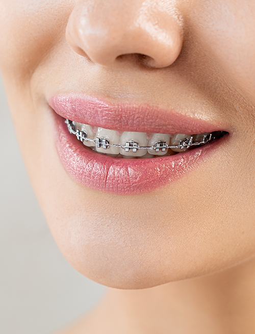 Traditional Fixed Braces