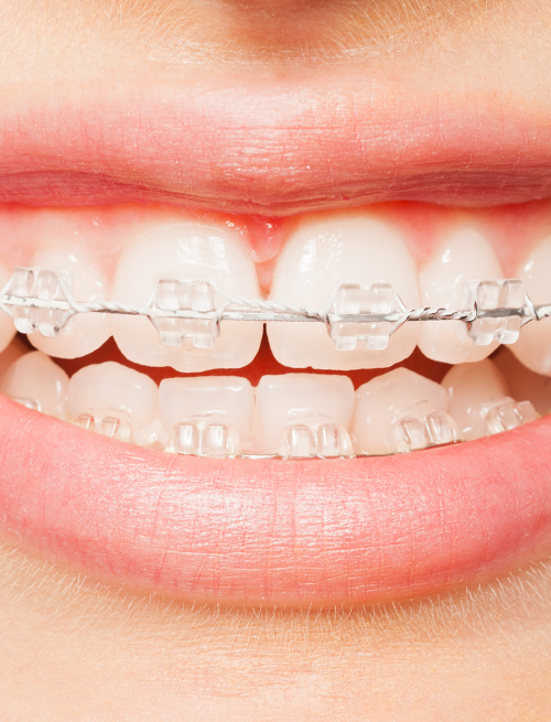 Clear Braces